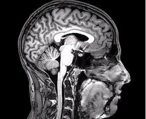 Imagen de resonancia magnética cerebral en corte lateral, mostrando estructuras internas del cerebro y tallo cerebral en alta definición.